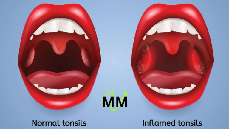 Can Tonsils Grow Back After Being Removed? - Tymoff