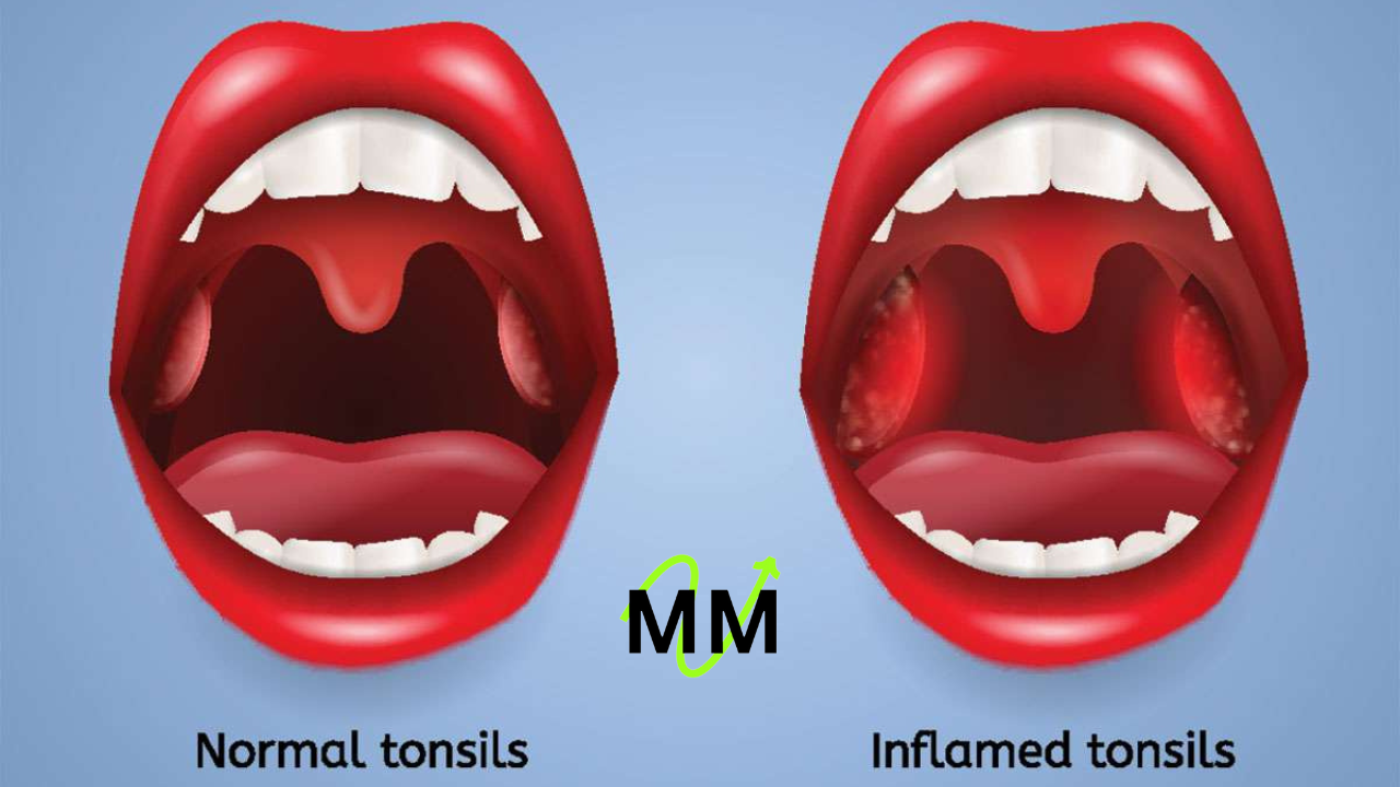 Can Tonsils Grow Back After Being Removed? - Tymoff